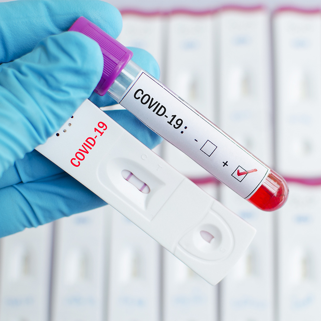 Тестове за антитела за коронавирус